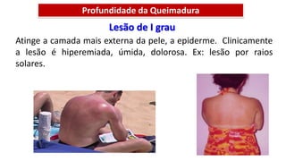 Lesão de I grau
Atinge a camada mais externa da pele, a epiderme. Clinicamente
a lesão é hiperemiada, úmida, dolorosa. Ex: lesão por raios
solares.
Profundidade da Queimadura
 