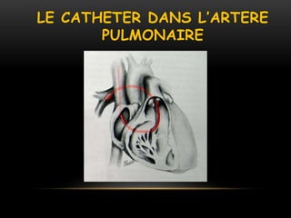 LE CATHETER DANS L’ARTERE
PULMONAIRE
 