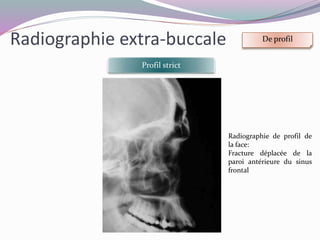 Radiographie extra-buccale De profil
Incidence de SCHULLER
Bouche ouverte Bouche fermée
 
