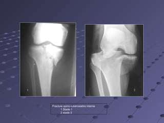 Les fractures articulaires du genou 