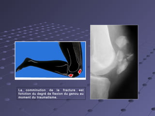 Les fractures articulaires du genou 