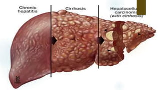 Les hepatites virales | PPT