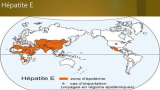 Hépatite E
 