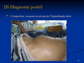 III-Diagnostic positif
 •   L’inspection: voussure au niveau de l’hypochondre droit




                                                               10
 