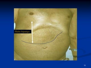 Flèche hépatique




                   15
 