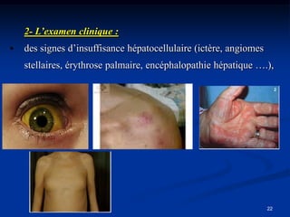 2- L’examen clinique :
•   des signes d’insuffisance hépatocellulaire (ictère, angiomes
    stellaires, érythrose palmaire, encéphalopathie hépatique ….),




                                                                   22
 