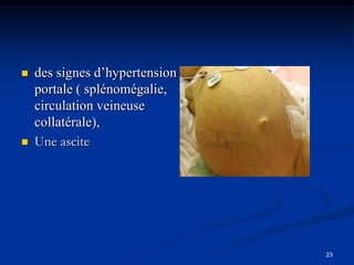    des signes d’hypertension
    portale ( splénomégalie,
    circulation veineuse
    collatérale),
   Une ascite




                                23
 