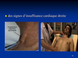    des signes d’insuffisance cardiaque droite




                                                 24
 