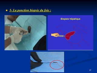    5- La ponction biopsie du foie :




                                       27
 