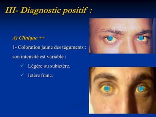 III- Diagnostic positif :

  A) Clinique ++
  1- Coloration jaune des téguments :
  son intensité est variable :
       Légère ou subictère.
       Ictère franc.




                                        11
 