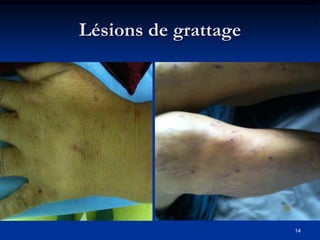 Lésions de grattage




                      14
 