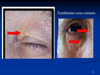 Xanthomes sous cutanés




                    15
 