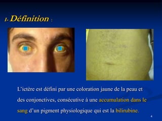I-   Définition :




       L’ictère est défini par une coloration jaune de la peau et
       des conjonctives, consécutive à une accumulation dans le
       sang d’un pigment physiologique qui est la bilirubine.
                                                                    4
 