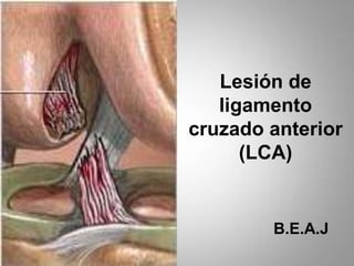Lesión de
ligamento
cruzado anterior
(LCA)

B.E.A.J

 