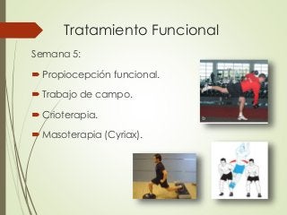 Tratamiento Funcional
Semana 5:
 Propiocepción funcional.
 Trabajo de campo.
 Crioterapia.
 Masoterapia (Cyriax).
 