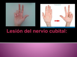 El nervio cubital es un nervio mixto, rama
medial del plexo braquial, se origina de la raíz
cervical VIII y I dorsal, el n...