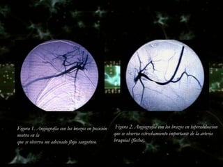 Figura 1. Angiografía con los brazos en posición    Figura 2. Angiografía con los brazos en hiperabduccion
neutra en la                                       que se observa estrechamiento importante de la arteria
que se observa un adecuado flujo sanguíneo.        braquial (flecha).
 