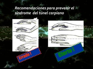 Recomendaciones para prevenir el
síndrome del túnel carpiano
 