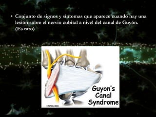 Tipo I

   El nervio cubital se encuentra envuelto en el canal de
    Guyon, existen anormalidades motoras y sensitivas

...