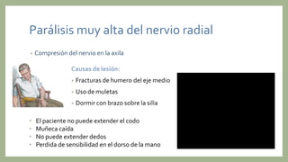 Parálisis muy alta del nervio radial
• Compresión del nervio en la axila
• El paciente no puede extender el codo
• Muñeca caída
• No puede extender dedos
• Perdida de sensibilidad en el dorso de la mano
 