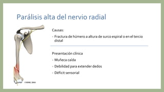 Parálisis alta del nervio radial
Causas:
• Fractura de húmero a altura de surco espiral o en el tercio
distal
Presentación clínica
• Muñeca caída
• Debilidad para extender dedos
• Déficit sensorial
 