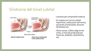 Síndrome del túnel cubital
• Lesiones por compresión externa.
• En sujetos con nervio cubital
hipermóvil, subluxación del nervio,
pacientes anestesiados, lesiones
de béisbol, etc.
• Otras causas: cúbito valgo en los
niños, a menudo producido por
fracturas, diabetes, alcoholismo,
etc.
 