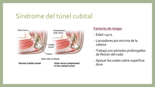 Síndrome del túnel cubital
Factores de riesgo:
• Edad >40 a.
• Lanzadores por encima de la
cabeza
• Trabajo con periodos prolongados
de flexión del codo
• Apoyar los codos sobre superficie
dura
 