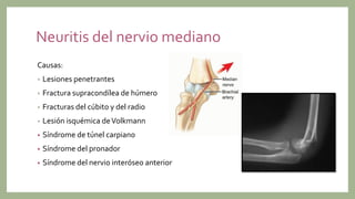 Neuritis del nervio mediano
Causas:
• Lesiones penetrantes
• Fractura supracondílea de húmero
• Fracturas del cúbito y del radio
• Lesión isquémica deVolkmann
• Síndrome de túnel carpiano
• Síndrome del pronador
• Síndrome del nervio interóseo anterior
 