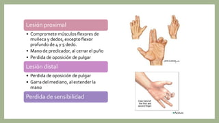 Lesión proximal
• Compromete músculos flexores de
muñeca y dedos, excepto flexor
profundo de 4 y 5 dedo.
• Mano de predicador, al cerrar el puño
• Perdida de oposición de pulgar
Lesión distal
• Perdida de oposición de pulgar
• Garra del mediano, al extender la
mano
Perdida de sensibilidad
 