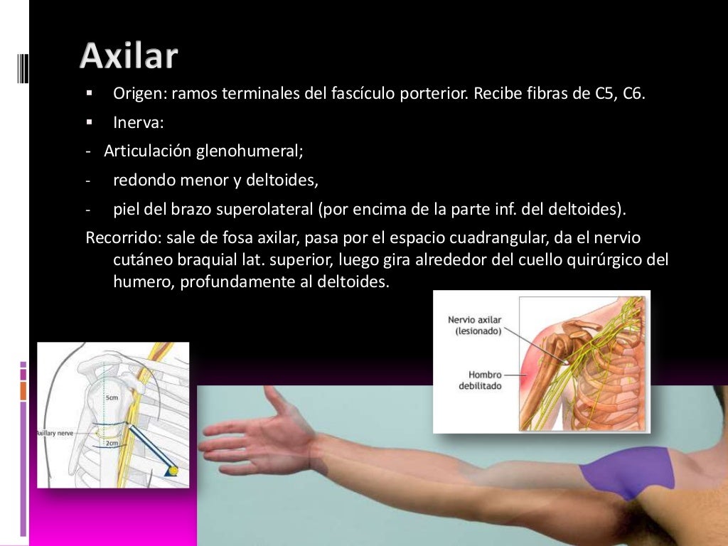 Lesión de plexo braquial, fisioterapia Lesión de plexo braquial, fisioterapia