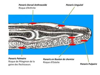 Panaris Dorsal Anthracoïde                Panaris Unguéal
         Risque d’Arthrite




Panaris Palmaire               Panaris en Bouton de chemise
Risque de Phlegmon de la       Risque d’Osteite
gaine des flechisseurs                                         Panaris Pulpaire
 