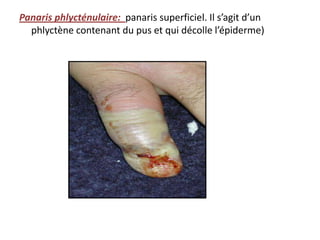 Panaris phlycténulaire: panaris superficiel. Il s’agit d’un
  phlyctène contenant du pus et qui décolle l’épiderme)
 
