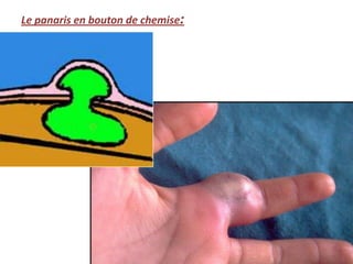 Le panaris en bouton de chemise:
 