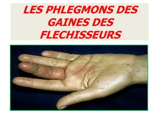 LES PHLEGMONS DES
    GAINES DES
   FLECHISSEURS
 