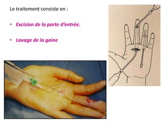 Le traitement consiste en :

• Excision de la porte d’entrée.

• Lavage de la gaine
 