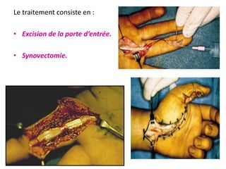 Le traitement consiste en :

• Excision de la porte d’entrée.

• Synovectomie.
 