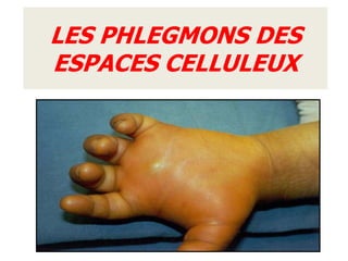 LES PHLEGMONS DES
ESPACES CELLULEUX
 