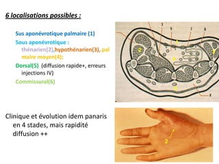 6 localisations possibles :

   Sus aponévrotique palmaire (1)
   Sous aponévrotique :                            1
     thénarien(2),hypothénarien(3), pal    2           3
     maire moyen(4);                               4
   Dorsal(5) (diffusion rapide+, erreurs
     injections IV)
   Commissural(6)
                                                   5




Clinique et évolution idem panaris
   en 4 stades, mais rapidité
   diffusion ++
                                               2
 