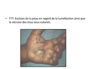 • TTT: Excision de la peau en regard de la tuméfaction ainsi que
  la nécrose des tissu sous-cutanés.
 