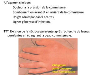 A l’examen clinique:
       Douleur à la pression de la commissure.
       Bombement en avant et en arrière de la commissure
       Doigts correspondants écartés
       Signes géneraux d’infection.

TTT: Excision de la nécrose purulente après recherche de fusées
  purulentes en épargnant la peau commissurale.




                                   Phlegmon
                                   après morsure
                                   1ere commissure
 