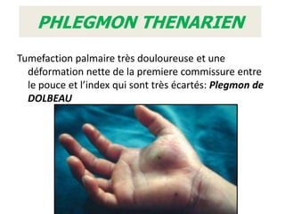 PHLEGMON THENARIEN
Tumefaction palmaire très douloureuse et une
  déformation nette de la premiere commissure entre
  le pouce et l’index qui sont très écartés: Plegmon de
  DOLBEAU
 