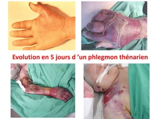 Evolution en 5 jours d ’un phlegmon thénarien
 