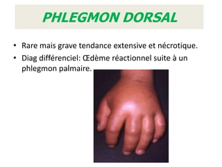 PHLEGMON DORSAL
• Rare mais grave tendance extensive et nécrotique.
• Diag différenciel: Œdème réactionnel suite à un
  phlegmon palmaire.
 