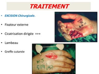 TRAITEMENT
       TRAITEMENT
• EXCISION Chirurgicale.

• Fixateur externe

• Cicatrisation dirigée +++

• Lambeau

• Greffe cutanée
 