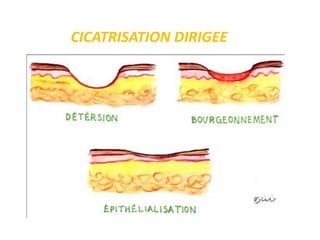 CICATRISATION DIRIGEE
 
