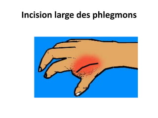 Incision large des phlegmons
 