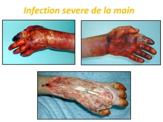 Infection severe de la main
 