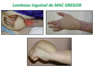 Lambeau inguinal de MAC GREGOR
 