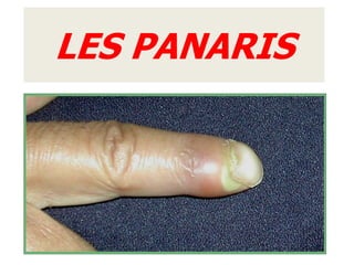 LES PANARIS
 