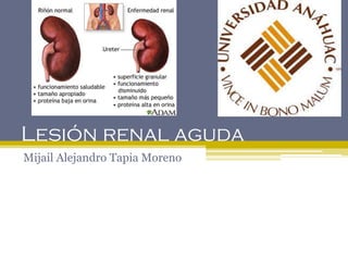 Lesión renal aguda
Mijail Alejandro Tapia Moreno
 